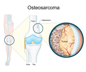 Diagram of osteosarcoma in a long bone with a magnified view of a tumor in the bone near the knee.