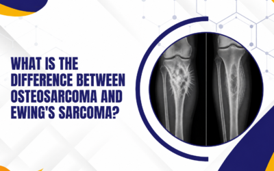 What Is the Difference Between Osteosarcoma and Ewing’s Sarcoma?