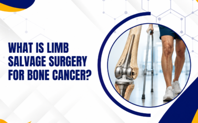 What Is Limb Salvage Surgery for Bone Cancer?