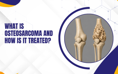 What Is Osteosarcoma and How Is It Treated?