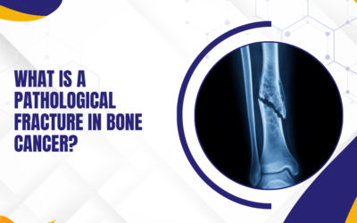 What Is a Pathological Fracture in Bone Cancer?