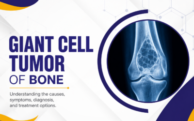 Giant Cell Tumor of Bone: Symptoms, Causes, Diagnosis & Treatment