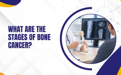 What Are the Stages of Bone Cancer?