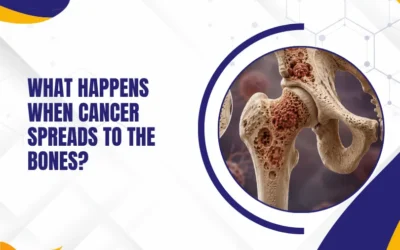 What Happens When Cancer Spreads to the Bones?