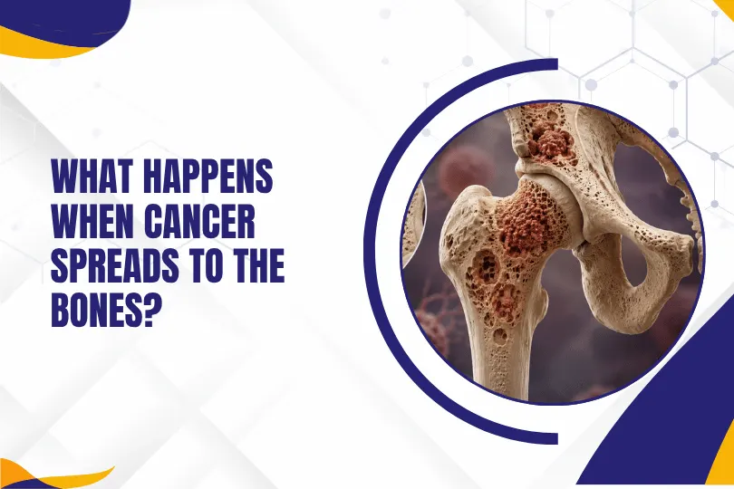 What Happens When Cancer Spreads to the Bones
